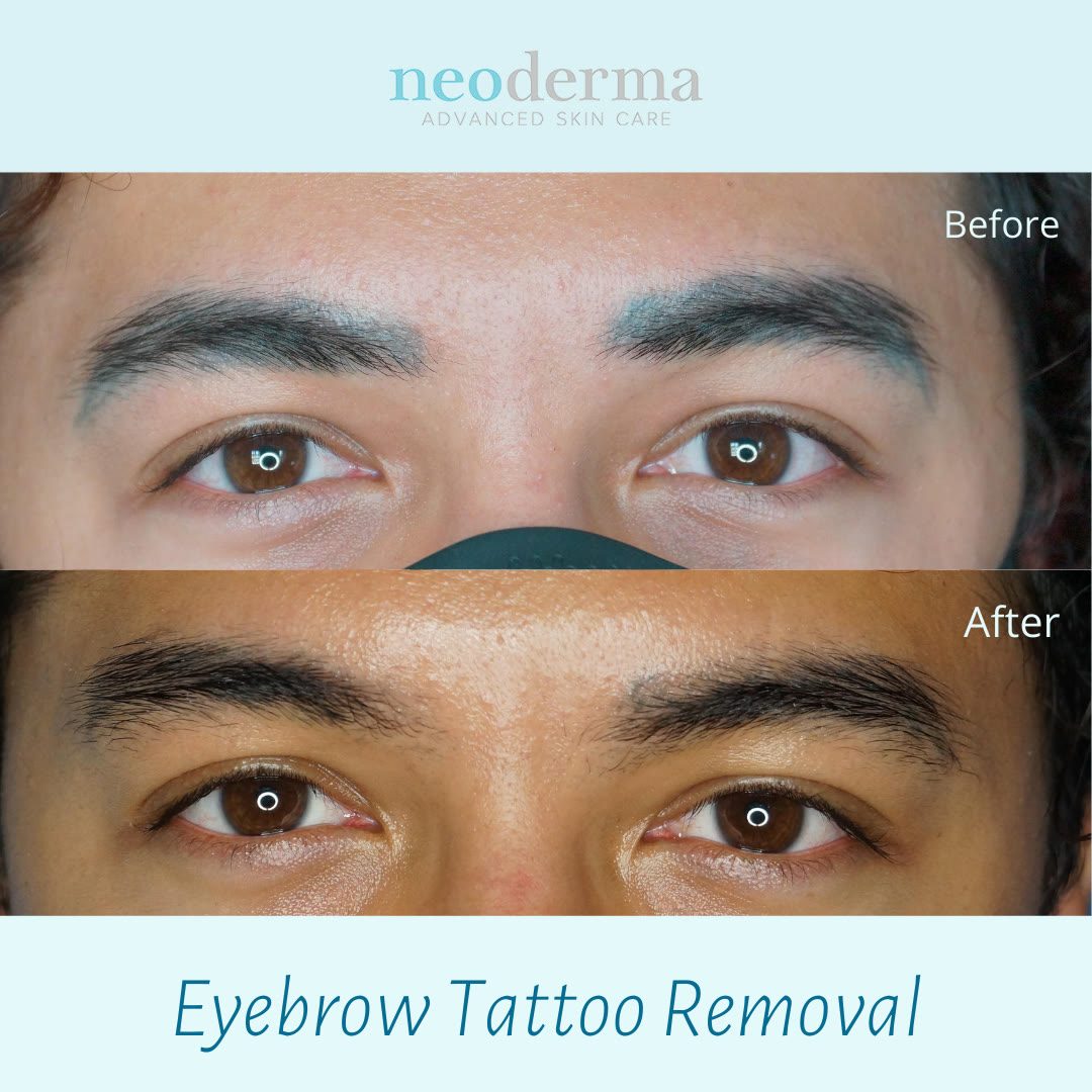 Before and after eyebrow tattoo removal at Neoderma in Anaheim: blue-gray tattoo pigment above and below the brows cleared with PicoWay, natural brow hair intact