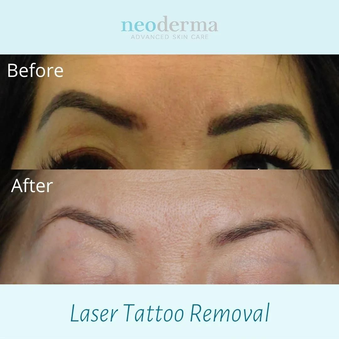Before and after eyebrow tattoo removal at Neoderma in Anaheim: dark tattooed brows removed with PicoWay for a soft, natural brow