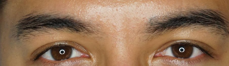 After eyebrow tattoo removal with PicoWay at Neoderma: the blue-gray pigment cleared, natural brow hair still in place