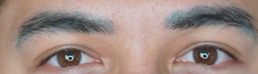 Before eyebrow tattoo removal: faded blue-gray tattoo pigment around both brows