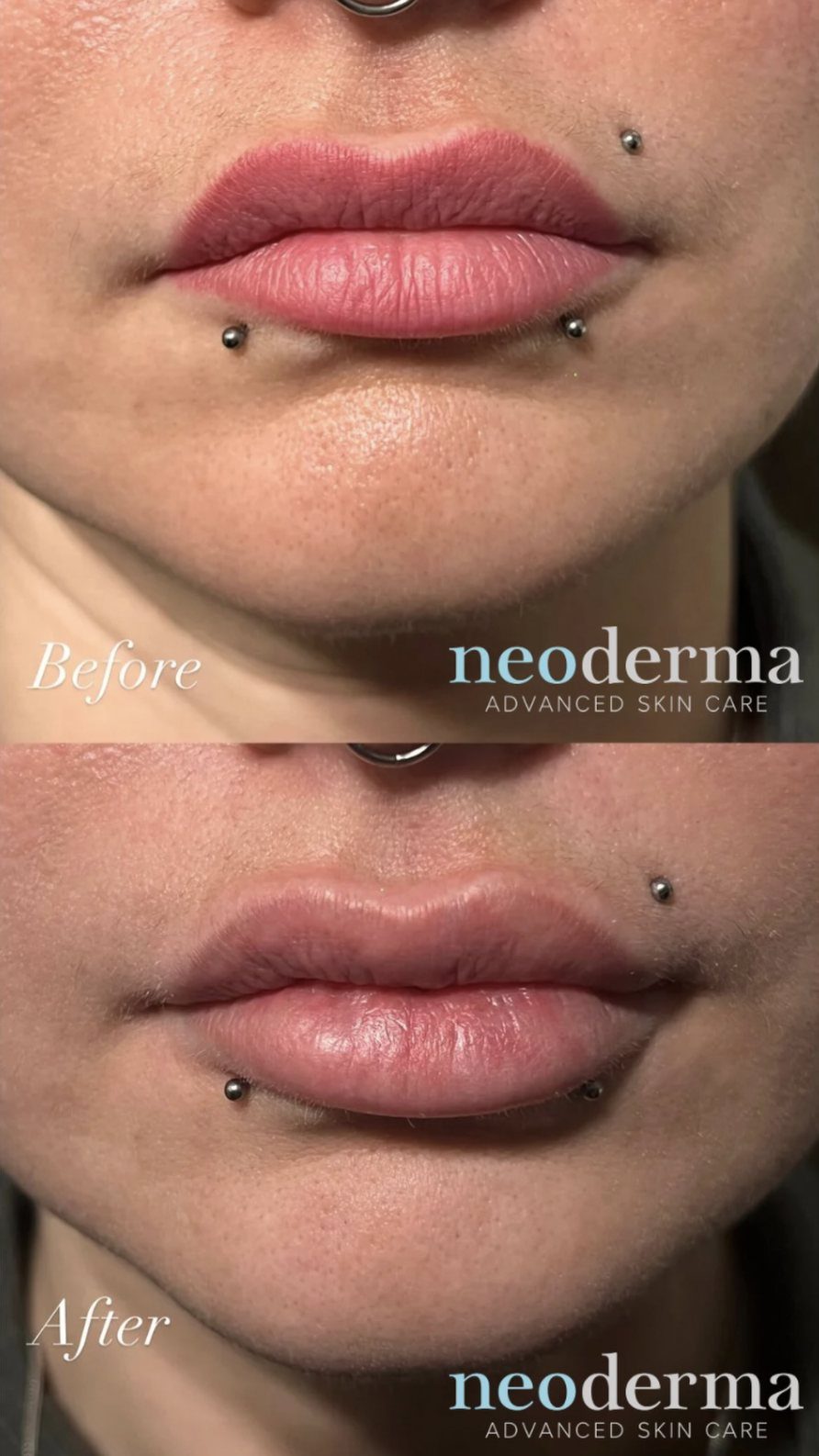 Before and after lip blush removal at Neoderma in Anaheim: saturated, over-drawn permanent lip color cleared back to a natural lip color and border